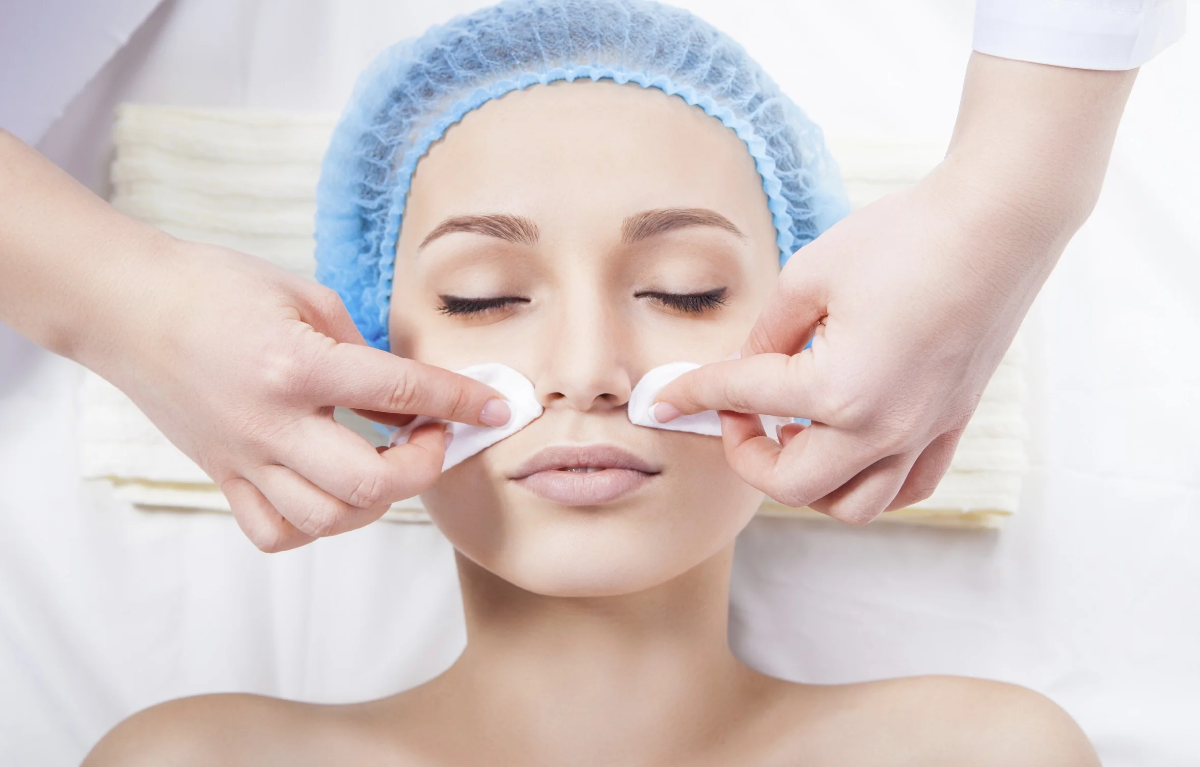 chemical peels