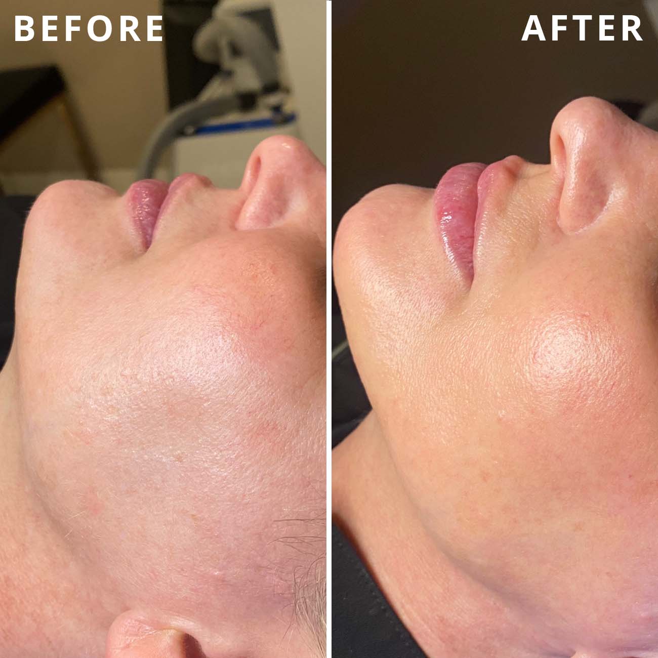 hydrafacial four