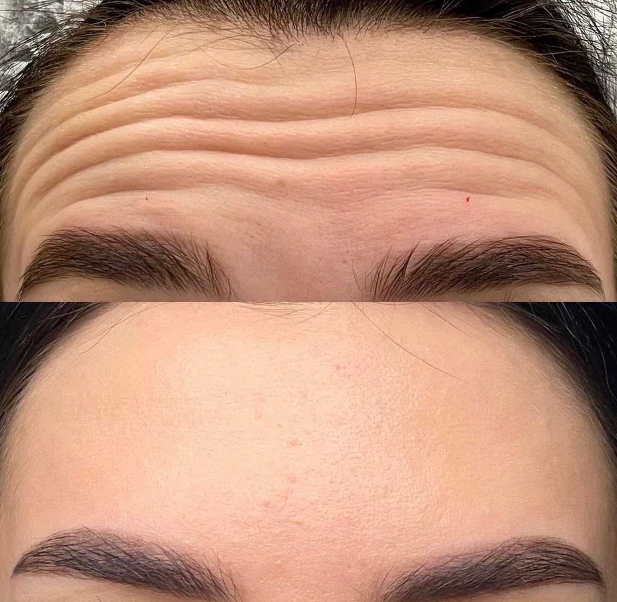 botox near me
