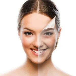 chemical peel