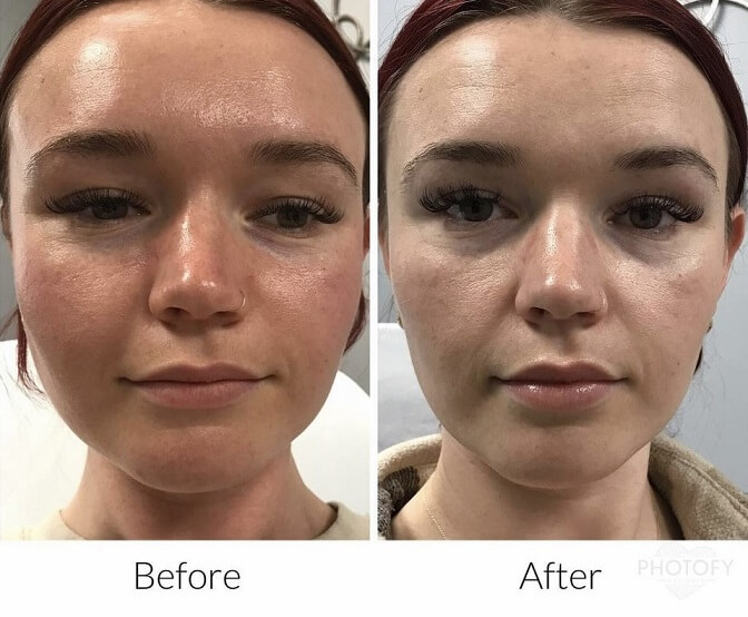 chemical peels before and after results pelle medical spa manchester nh 2